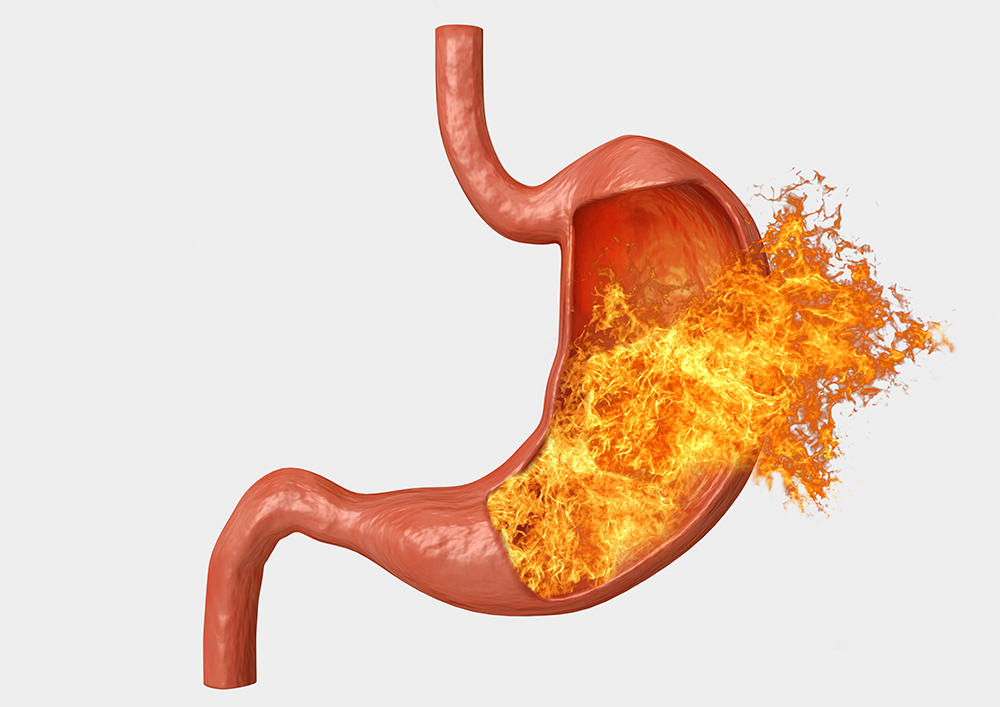 stomach fire. excessive acidity, indigestion, stomach disease, gastric ulcer, severe abdominal pain. 3D Rendering
